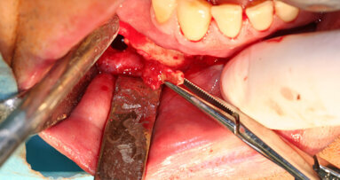 Naše zkušenosti s technikou kostní piezochirurgie po 15 letech klinického používání