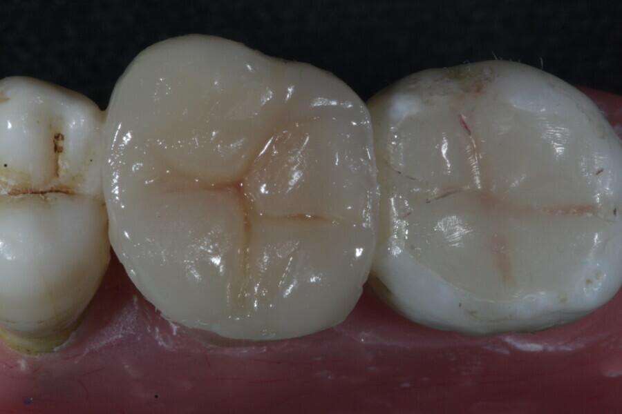Fig. 43b: The dentine composite layer (Estelite) is covered with an aesthetic enamel layer.