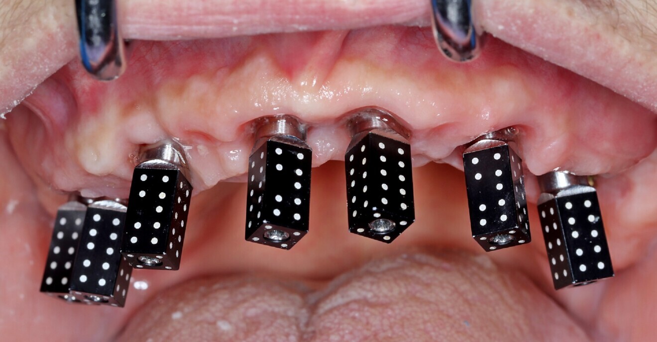 Fig. 2a: Photogrammetry. Manufacturer-specific scan bodies. 