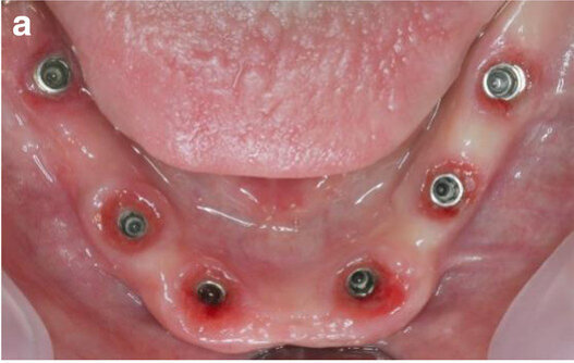 Fig. 14a: Occlusal, frontal and lateral views on the day of delivery, showing healthy peri-implant mucosal conditions (a) and the final CAD/CAM restoration in situ (b–e).