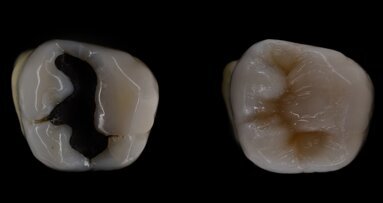 L'interdiction des amalgames avance à grands pas... Quelles sont les alternatives ?