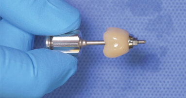 Titanium base implant cementation technique using PANAVIA SA Cement Universal