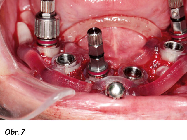 Implantace přes chirurgickou šablonu.
