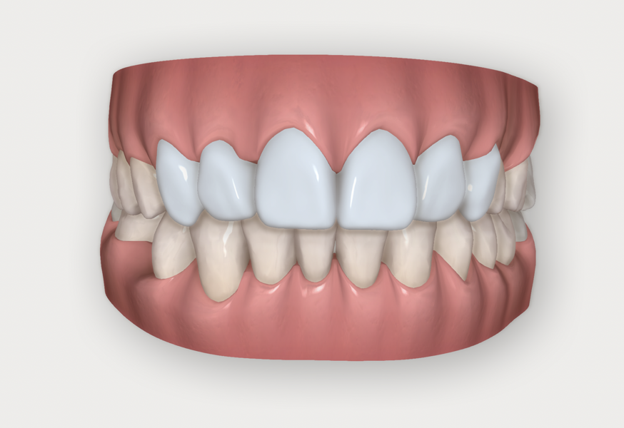 Fig. 6: ClinCheck with wax-up of the planned restorations.