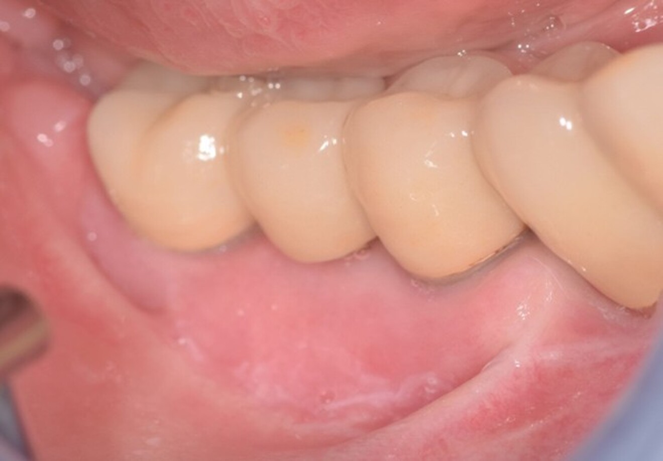 Stable peri-implant soft tissue with an adequate zone of attached mucosa eight years after prosthetic rehabilitation.