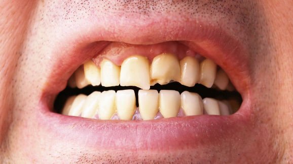 Предстоят клинични проучвания върху зъби с установени пукнатини