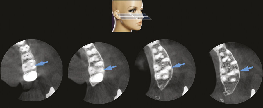 Fig. 2e - Le quattro sezioni assiali mostrano come la radice distovestibolare del primo molare sia vestibolare rispetto alla radice mesiovestibolare del secondo molare. Questa particolare situazione anatomica rappresenta una ovvia controindicazione all’approccio chirurgico.