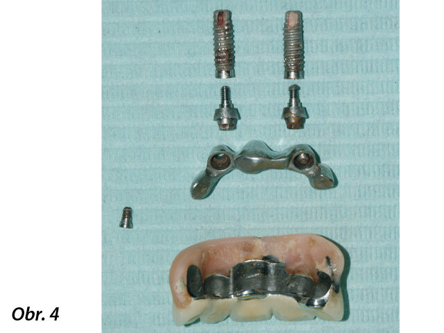 Konstrukce byla odšroubována, abutmenty odstraněny a implantáty snadno vyjmuty.