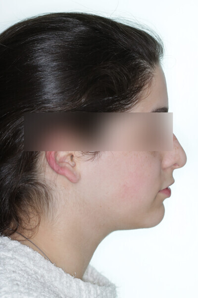 Fig. 2: Initial situation. Class II malocclusion patient.