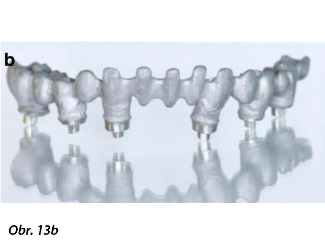 Chromkobaltová základní konstrukce vyrobená pomocí CAD/CAM jako jeden celek před (a, b) a po fazetování kompozitem (SR Nexco Paste, Ivoclar Vivadent), tedy hotovou definitivní fixní náhradu (c, d).