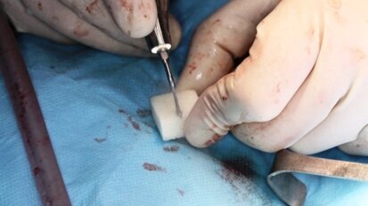 Osteovit jako materiał augmentacyjny – alternatywa dla kości autogennej