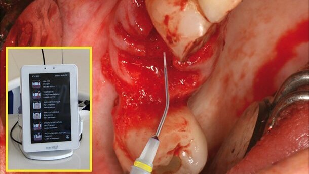 Chirurgie reconstructrice lasers assistée en omnipratique