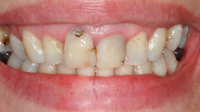 Approccio interdisciplinare paro-protesico di una riabilitazione in area estetica