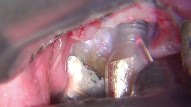 La tecnologia laser VSP nella gestione delle perimplantiti