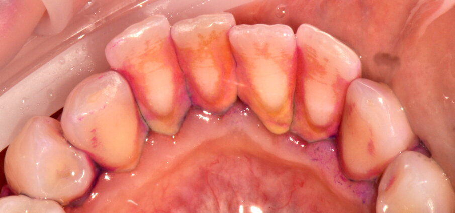 Figg. 1a-1c - Applicazione del rilevatore di placca che verrà usato come guida durante la terapia, nel versante vestibolare (1a), palatale (1b) e linguale (1c). Si noti lo scarso livello di igiene orale domiciliare e l’assenza di utilizzo dei presidi interdentali.