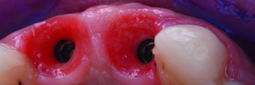 Figs. 25–26 : Après le retrait des piliers provisoires. Le tissu gingival est bien modelé. 