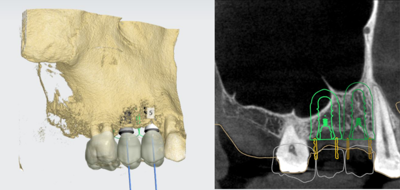 Figs. 3a & b: Alignment of the implants on the basis of the prosthetic restorations.