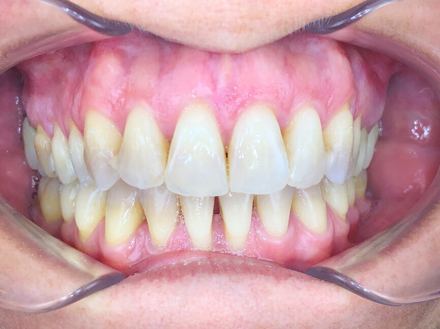 Photo de face fin de traitement (Copyright- Dr Edouard Negre)