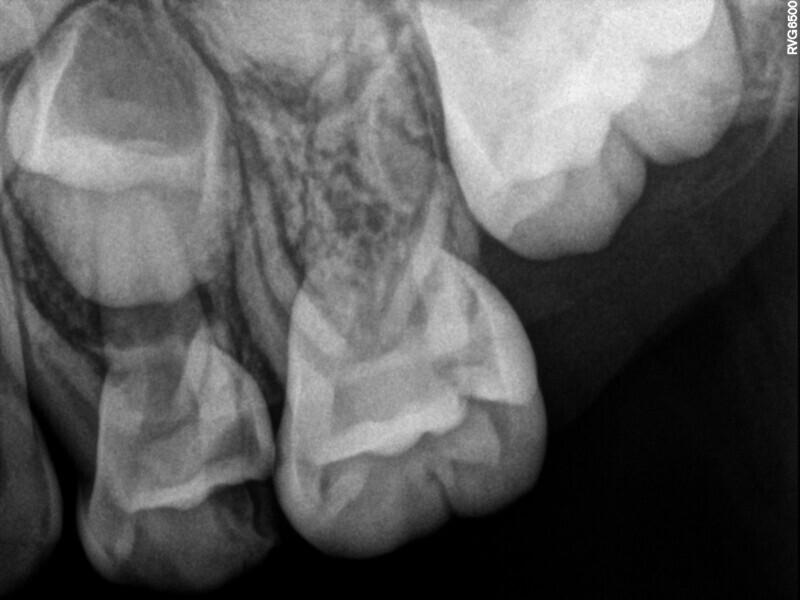 Fig. 20 : Radiographie initiale montrant une perte osseuse apicale.