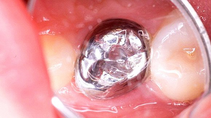 Las coronas son superiores a los empastes Las coronas son superiores a los empastes