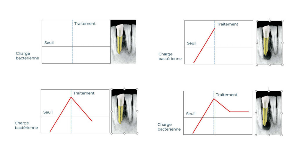 Pourquoi certaines lésions endodontiques guérissent et d’autres pas ?