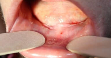 Leczenie  implantologiczne znacznego zaniku części zębodołowej żuchwy