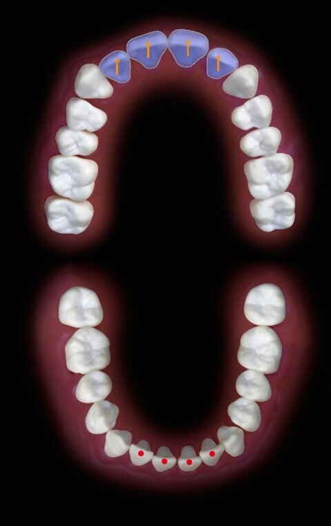 Fig. 3_Direzione dei tragitti di protrusiva dalla massima interscupidazione su edentulia totale. In protrusiva si avranno tragitti lineari a carico degli incisivi.