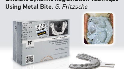 Efficient Dynamic Registration Technique Using Metal Bite.