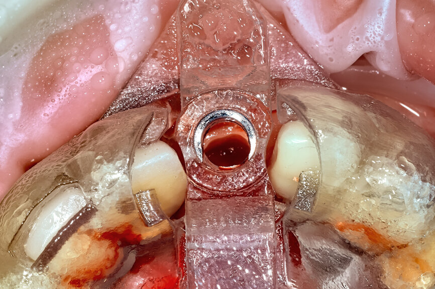 Fig. 19a: The second metal cylinder insert
allowed for the long, round diamond drills to shape the root into the desired crescent shape (a). The insert was removed to access the palatal root (b).
