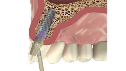 Un nuevo pilar que puede colocarse en distintos ángulos