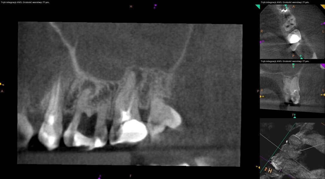 Fig. 7: Pre-op CBCT image showing a radiolucency above the apical parts of the MB roots of the maxillary first and second molars.