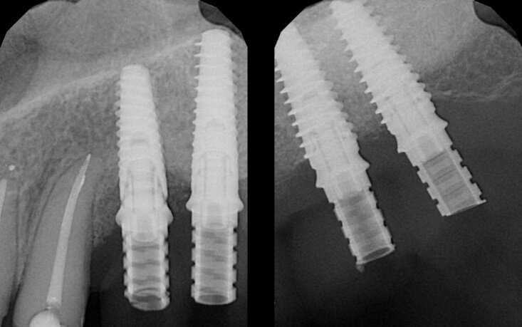 Fig. 8 - Radiografie endorali di controllo a 6 mesi dal posizionamento implantare. Si osserva un eccellente mantenimento dei livelli dei tessuti ossei peri-implantari.