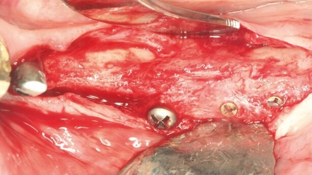 Augmentacja z wykorzystaniem indywidualnie frezowanego przeszczepu kości