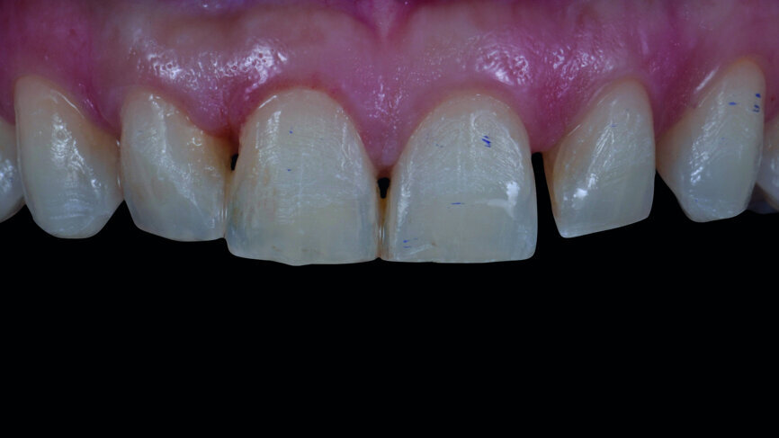 Fig. 7: Periodontal tissue of the anterior teeth six months after crown lengthening.