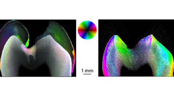 Mit Nanoforschung der Karies auf der Spur