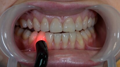 Biostymulacja laserem diodowym 635 nm w leczeniu nadwrażliwości