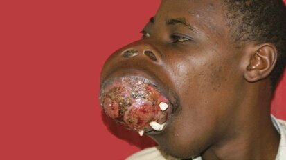 Plastic surgeons remove large jaw tumours