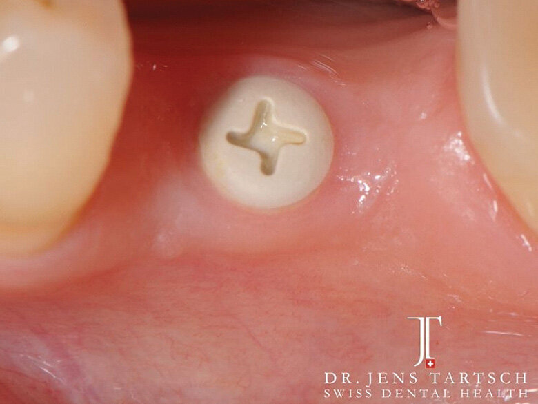 Fig. 7: Healing period with healing cap ZERAMEX XT. (Photo: Jens Tartsch, DMD)