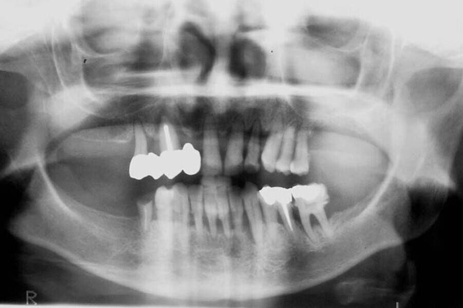 .Fig. 4 Prótesis Híbrida inmediata y radiografía control con 6 años post-operatorio