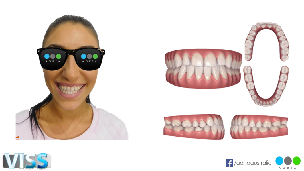 Fig. 42: Patient’s facial photograph before aligner treatment, alongside the Invisalign software simulation.