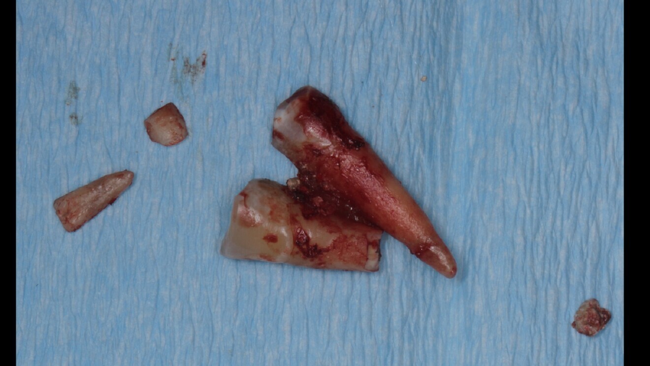 Fig. 7: Extracted tooth #14.