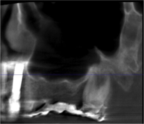 Fig. 1 - Sezione panorex CTCB pre-operatoria II quadrante con visione del seno mascellare.
