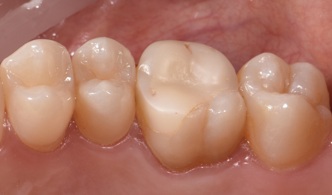 Fig. 1c: Initial clinical situation. Large composite restoration showing a microcracks in the tooth structure on the palatal surface.