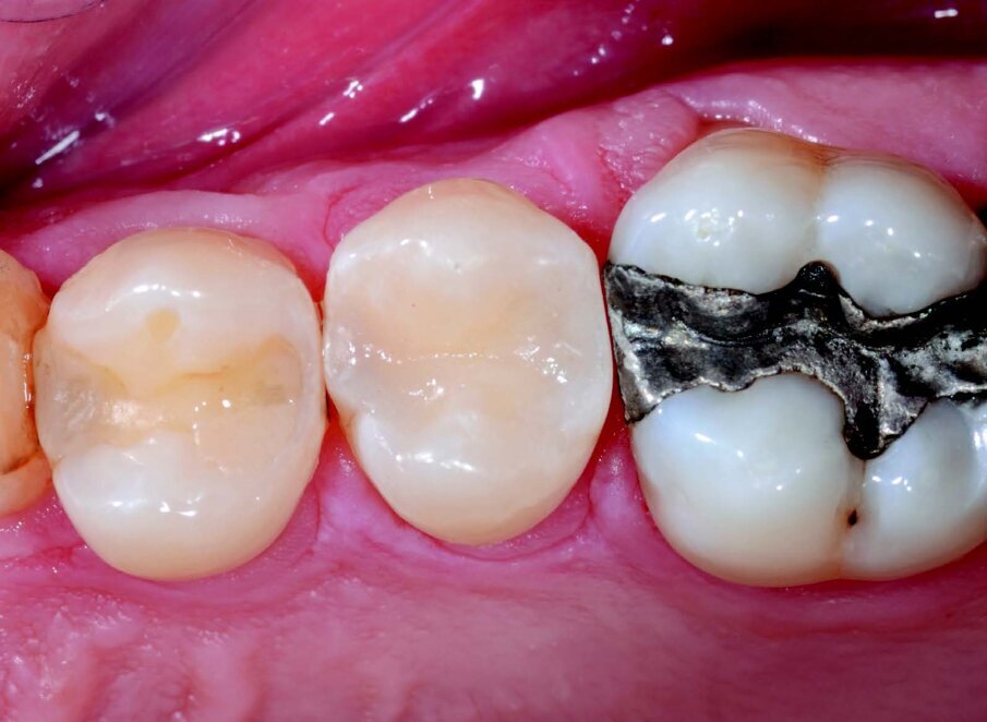 Post-op view after polishing and check occlusion. A good contact area is performed between elements 1.5 and 1.6.