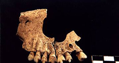 Βρέθηκε οδοντική έμφραξη από τη λίθινη εποχή