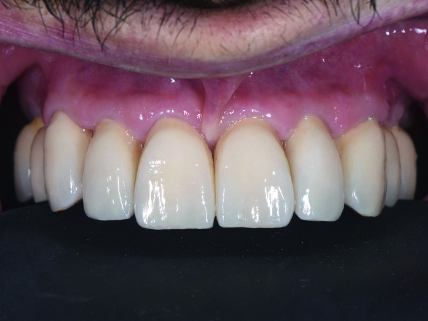 Fig. 15 : Cicatrisation des tissus mous deux semaines après le scellement : vue frontale des couronnes unitaires en zircone cubique.