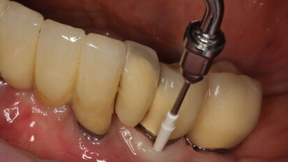 Guided Biofilm Therapy – Избягвайте рисковете при имплантите Guided Biofilm Therapy – Избягвайте рисковете при имплантите