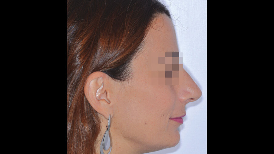 Figg. 4a-4c_Foto extraorali di inizio trattamento.