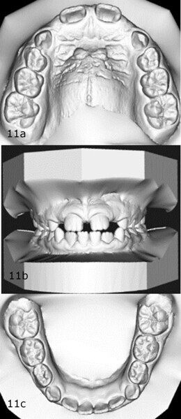 Figs. 11a–c: Comparison of the models at the (a–c) start and (d–f) end of treatment.