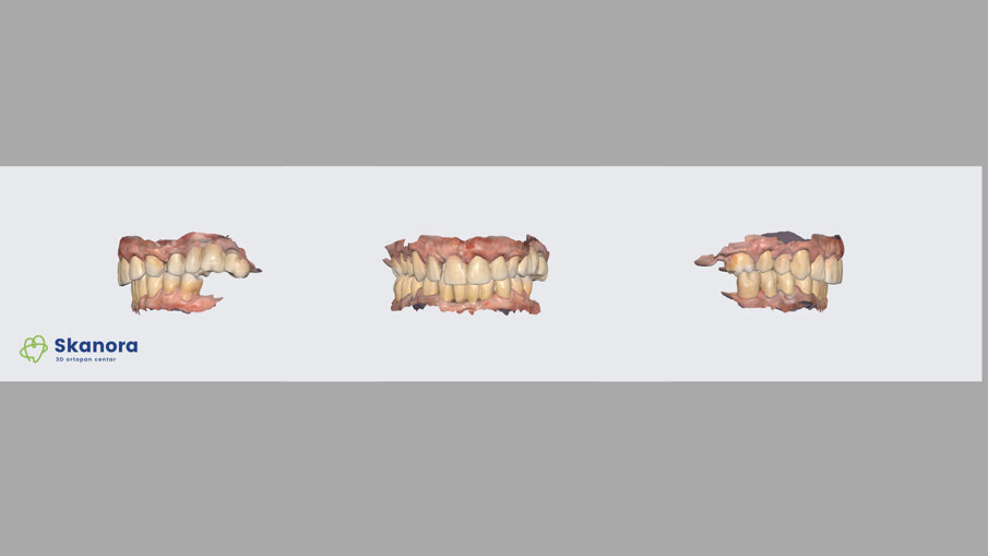 Slika 1a intraoralni sken inicijalnog stanja pacijenta (dr Dejan Stajčić)